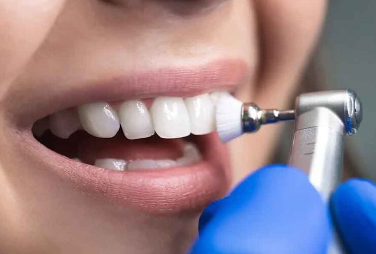 The Benefits of Professional Dental Cleanings